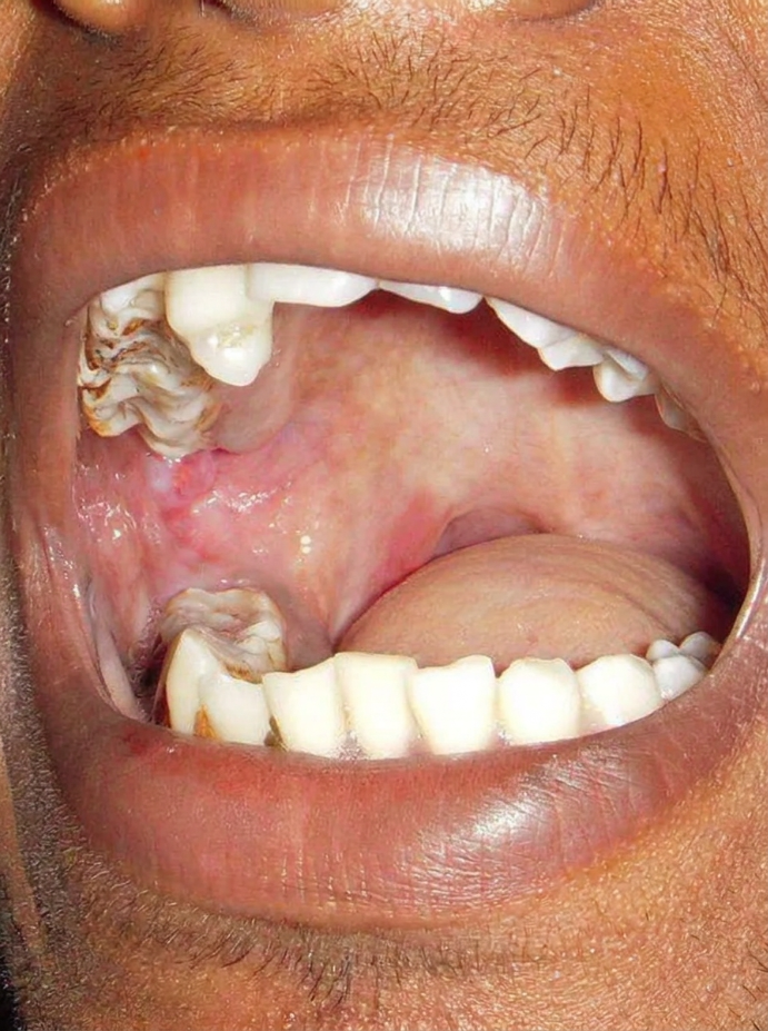 Oral Submucous Fibrosis (OSMF) Management